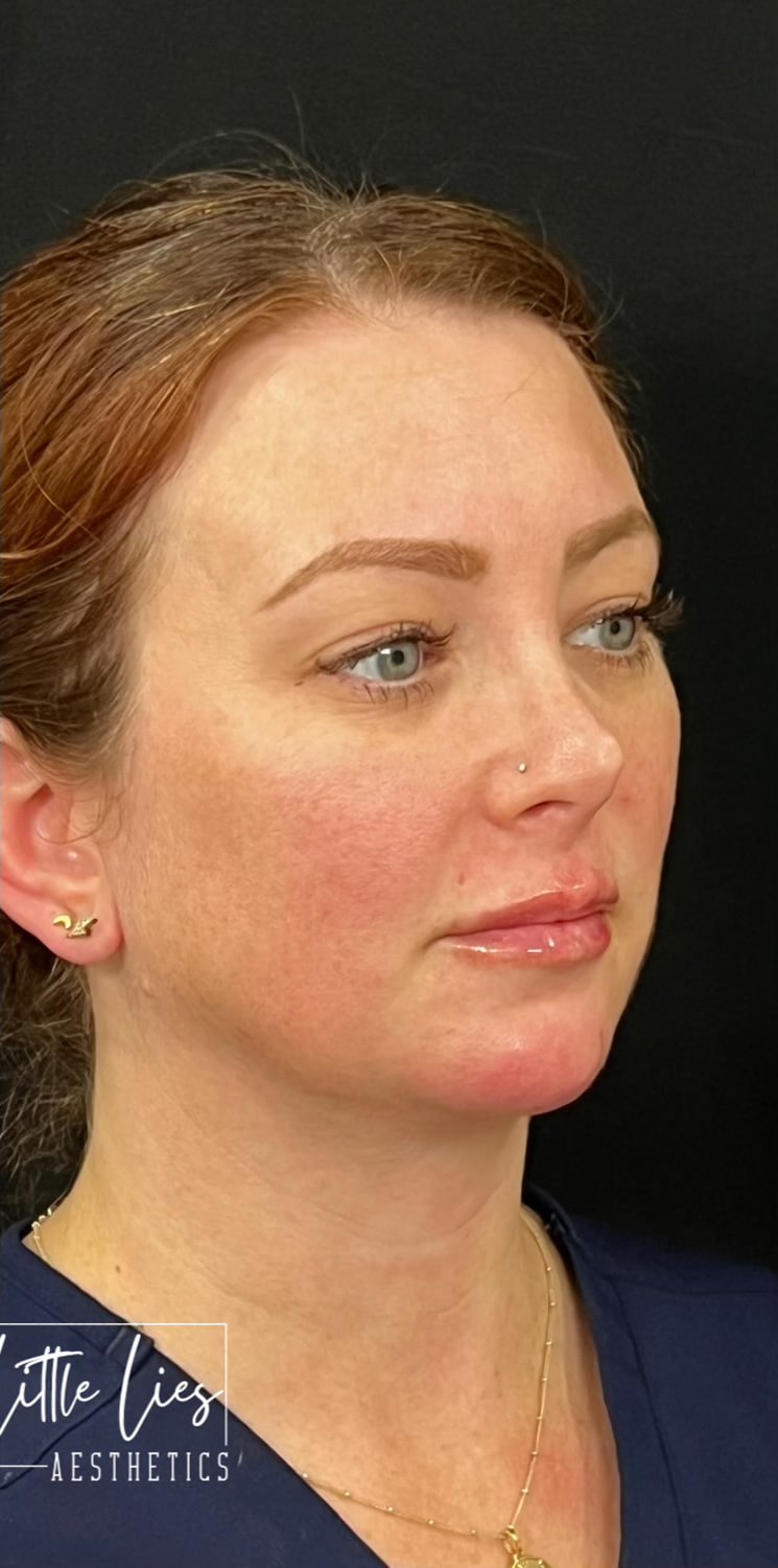 After Image: Lip Filler - right-front-oblique