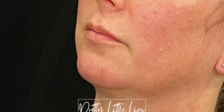 Before Image: Lip Filler - left-front-oblique