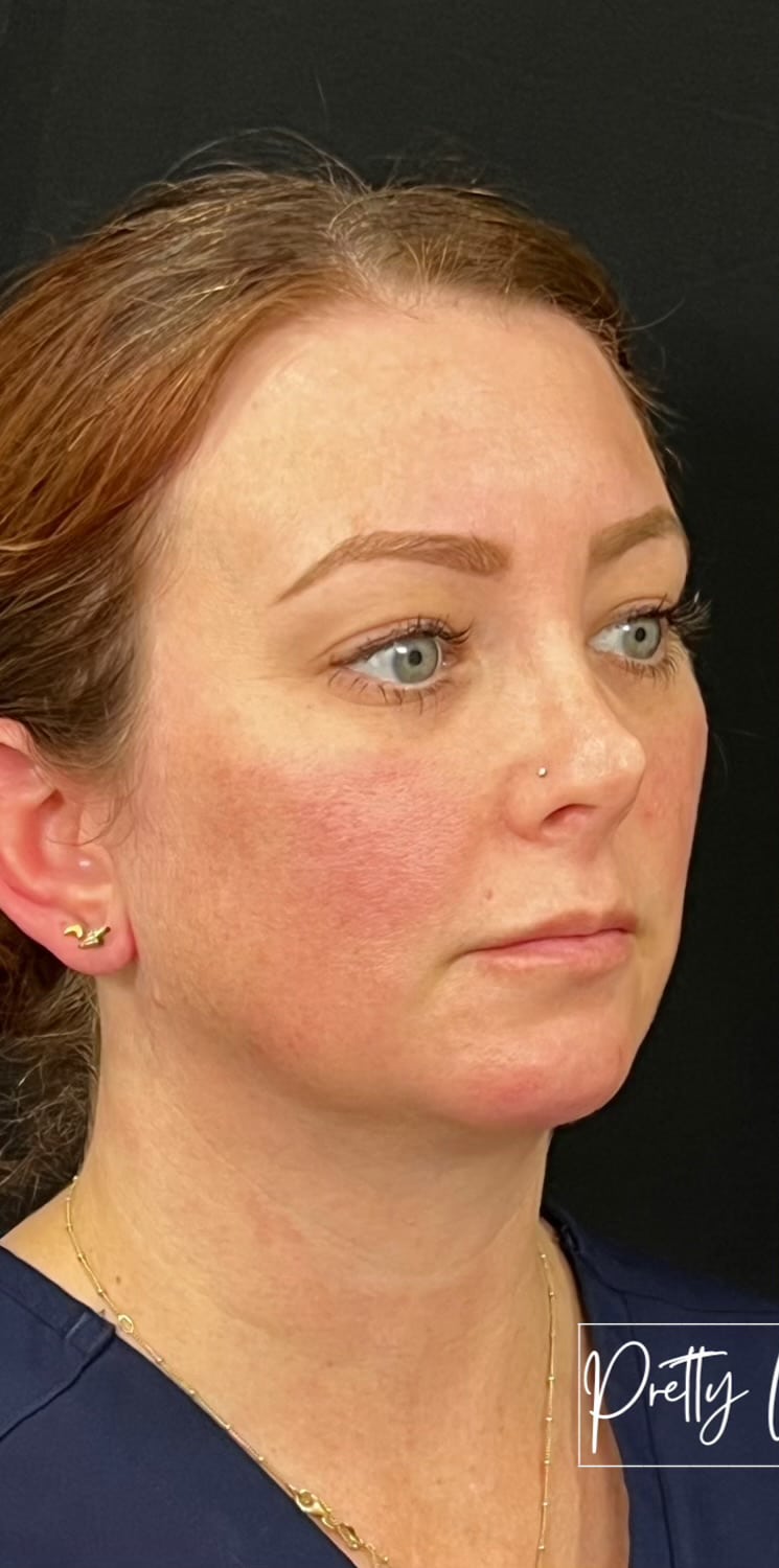 Before Image: Lip Filler - right-front-oblique