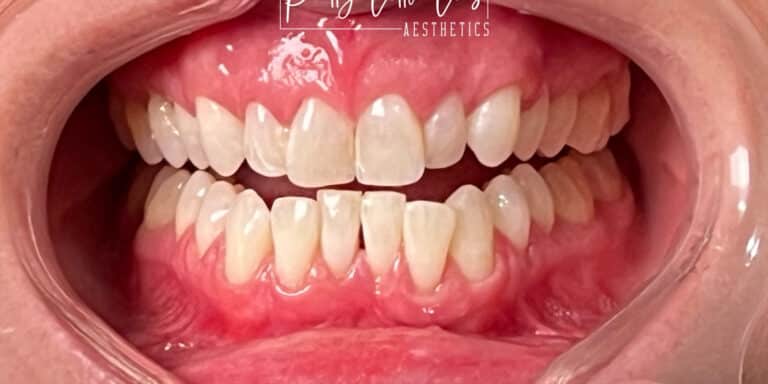 After Image: Teeth Whitening - front
