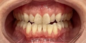 Before Image: Teeth Whitening