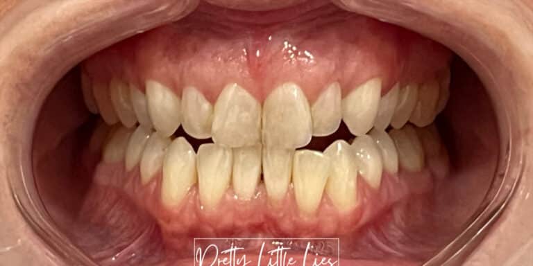 Before Image: Teeth Whitening - front