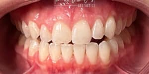 After Image: Teeth Whitening
