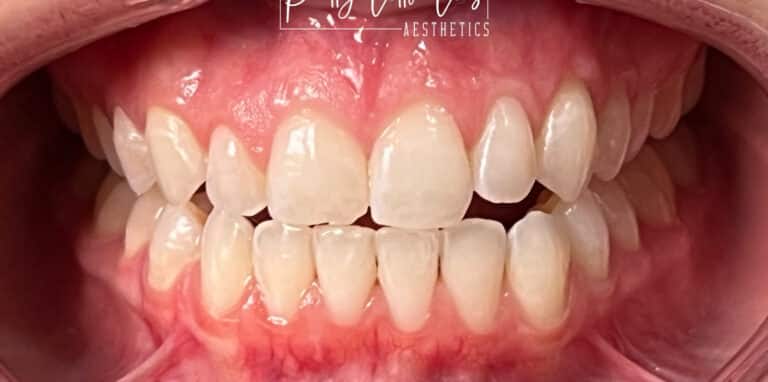 After Image: Teeth Whitening - front