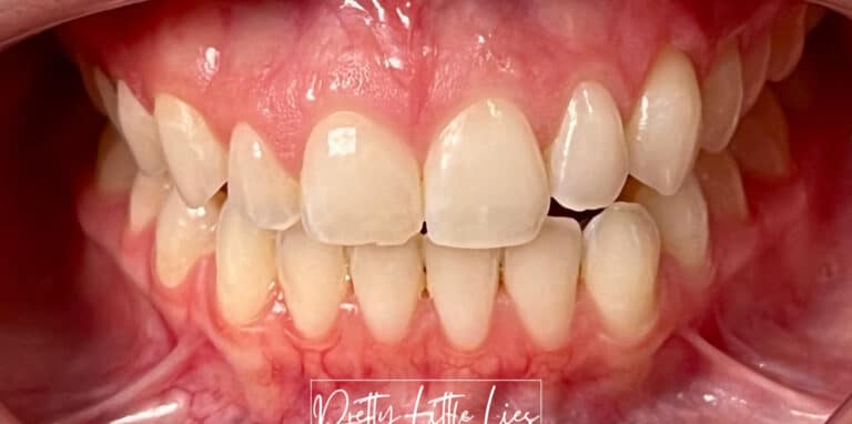Before Image: Teeth Whitening - front