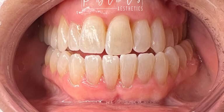 After Image: Teeth Whitening - front