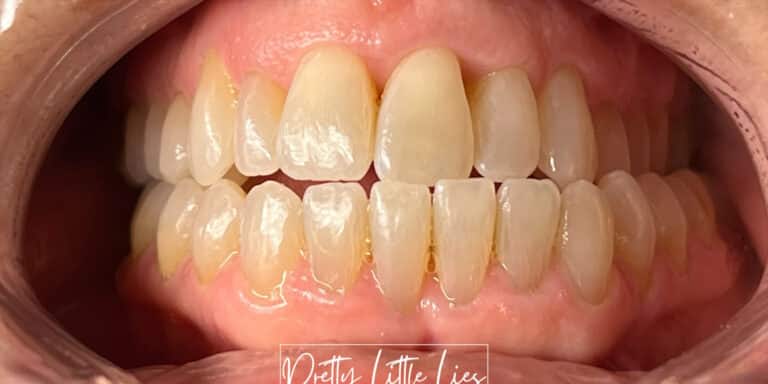 Before Image: Teeth Whitening - front
