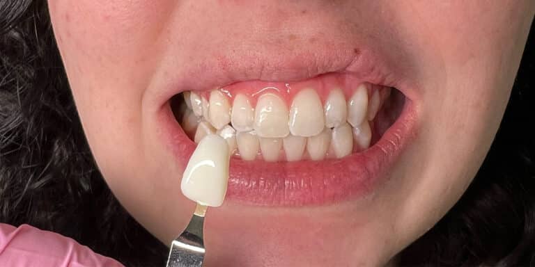 After Image: Teeth Whitening - front