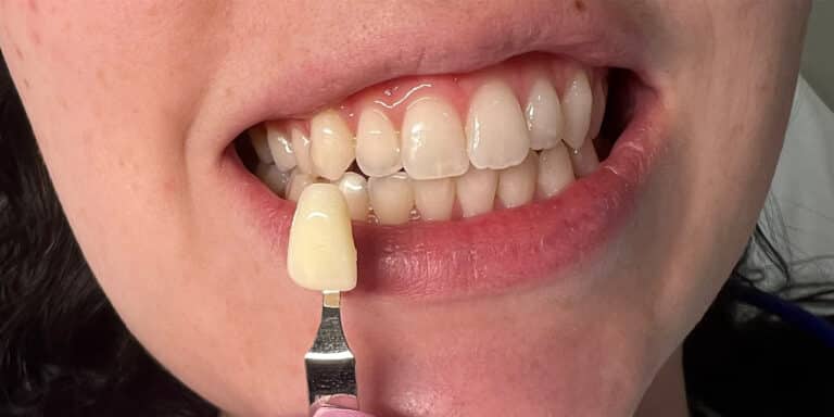 Before Image: Teeth Whitening - front