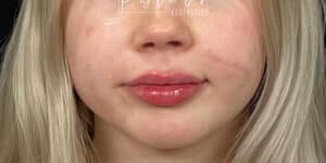 After Image: Lip Filler