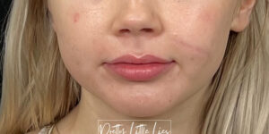 Before Image: Lip Filler