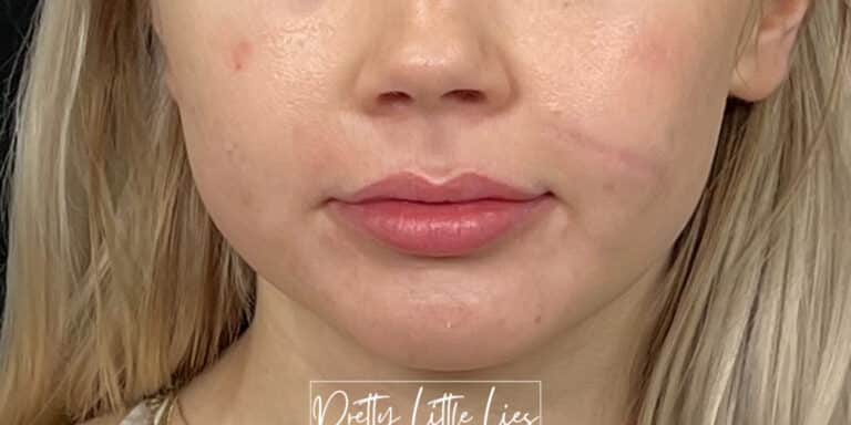 Before Image: Lip Filler - front