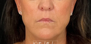 Before Image: Lip Filler