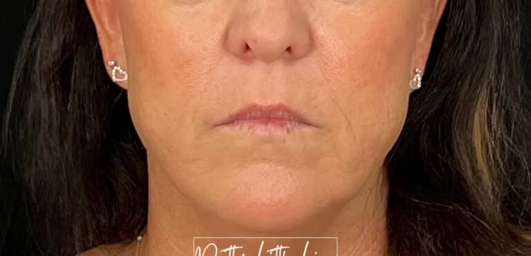 Before Image: Lip Filler - front