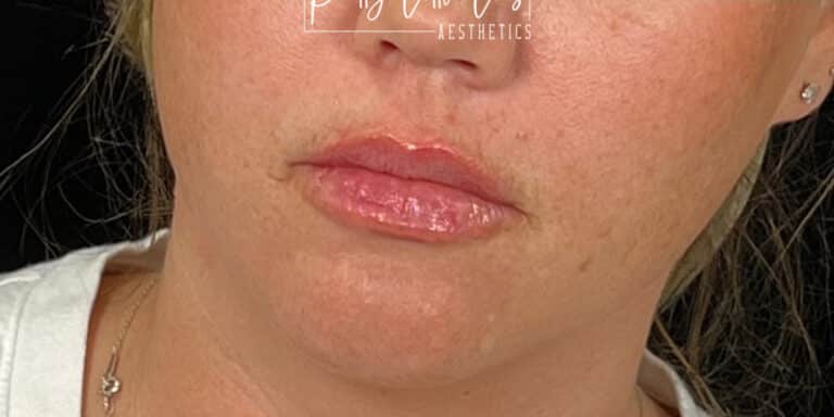 After Image: Lip Filler - front