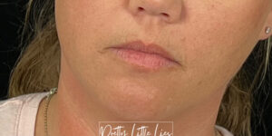 Before Image: Lip Filler