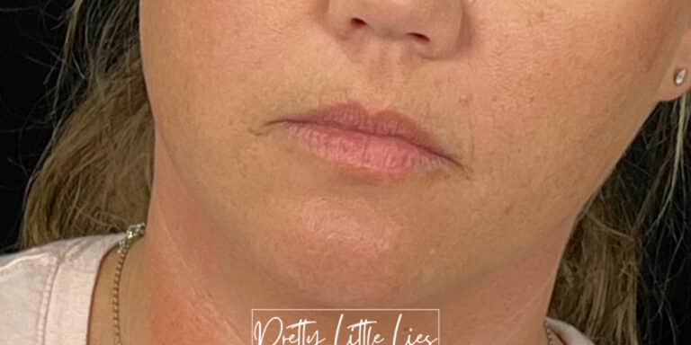 Before Image: Lip Filler - front