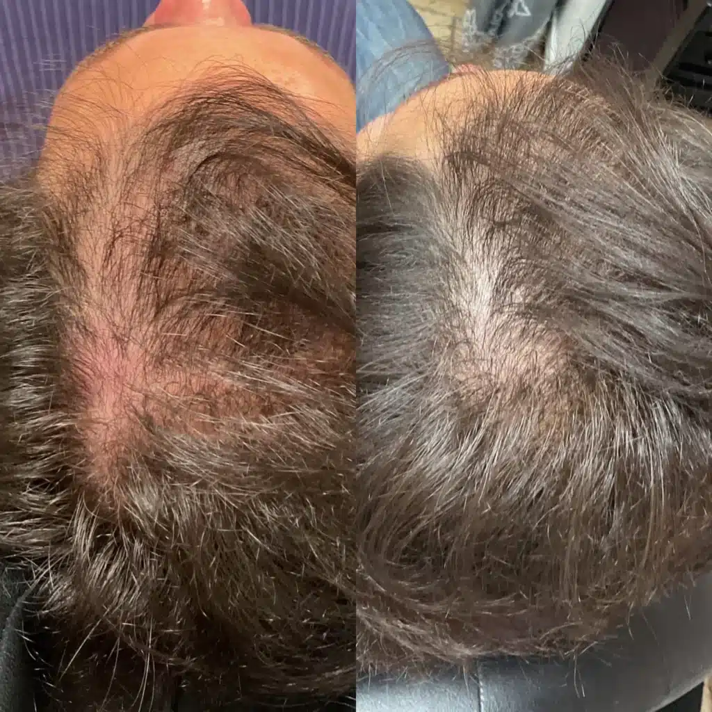 before-after-microneedling-restoration-scaled.jpeg